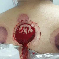 خدمات حجامت.فصدخون.بادکش