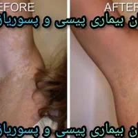 درمان پیسی / پسوریازیس/ مشکلات پوستی و ایمنی