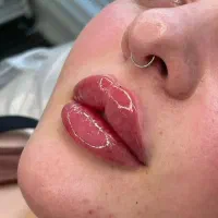 تخفیف ویژه خدمات و آموزش ژل بوتاکس