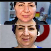 سوپر لیفتینگ نخ۳۶ خار تضمین شده توسط استاد دانشگاه|خدمات آرایشگری و زیبایی|مشهد, سناباد|دیوار