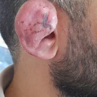 شکستن گوش در همدان