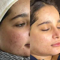 پذیرش مدل فیشیال باقیمت ویژه برای تکمیل نمونه کار