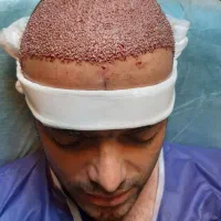 جشنواره کاشت مو و ابرو در تهران و کرج|خدمات آرایشگری و زیبایی|تهران, صاحبقرانیه|دیوار