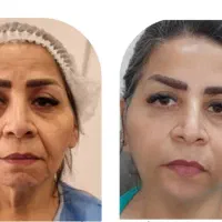 مدل زیبایی مکس لیفت