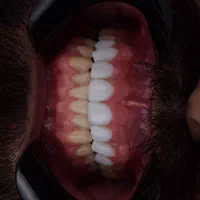کامپوزیت لمینت بلچینگ روکش بلفارو غبغب لیفت صورت|خدمات آرایشگری و زیبایی|مشهد, فردوسی|دیوار