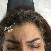 پاکسازی و فیشیال پوست  ازبین بردن لک مخصوص بانوان|خدمات آرایشگری و زیبایی|آمل, |دیوار
