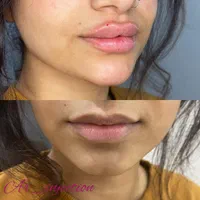 آموزش و تزریق ژل و بوتاکس|خدمات آرایشگری و زیبایی|مسجد سلیمان, |دیوار