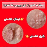 برطرف کردن زگیل و تبخال تناسلی