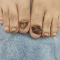 بیماری های ناخن تیرگی قوزک پدیکور آقایان و خانم ها|خدمات آرایشگری و زیبایی|زنجان, |دیوار