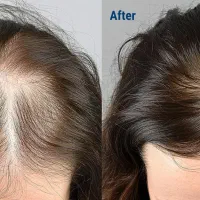 درمان ریزش مو