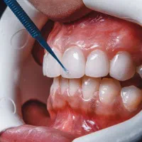 کارت تخفیف دندانپزشکی/ارتودنسی/کامپوزیت با نیم بها|کارت هدیه و تخفیف|گرگان, |دیوار
