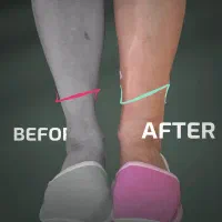 آف۵۰٪فیلربادی۱۰۰سیسی۱۱تومن،بیکینی،هیپ دیپ،سینه پا