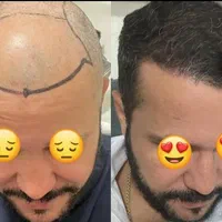 جشنواره‌کاشت مو و ابرو و ریش و‌سبیل