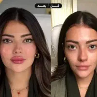 فیلر ژل بوتاکس