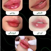 تزریق جوانسازها و ژل لب و گونه
