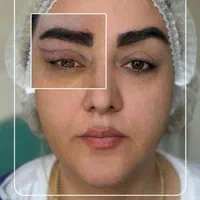 عمل پلک بالا بلفاروپلاستی|خدمات آرایشگری و زیبایی|شیراز, ملاصدرا|دیوار
