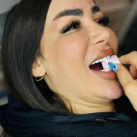 کامپوزیت دندان تمام سرامیکی 7میلیون