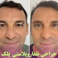 بلفارو پلاستی ( جراحی افتادگی پلک)آقایان و بانوان|خدمات آرایشگری و زیبایی|تهران, تهرانسر مرکزی|دیوار
