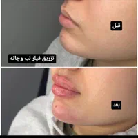 تزریق ژل وبوتاکس،پریسنگ،ارایش دائمصورت تاتوکل صورت|خدمات آرایشگری و زیبایی|گنبد کاووس, |دیوار