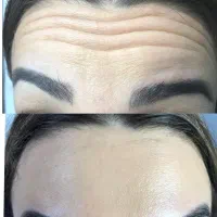 آف یلدایی تزریق ژل و بوتاکس|خدمات آرایشگری و زیبایی|ملایر, |دیوار