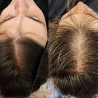 رفع دائمی سفیدی مو + رشد مجدد موها|آرایشی، بهداشتی، درمانی|تهران, طرشت|دیوار