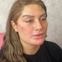 قسطی فیلربادی کانتور۴لیفت کره ای ژل لب هیپدیپ باسن