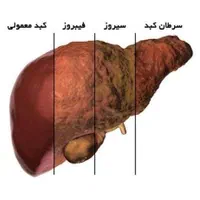 بهبود عملکرد کبد درمان قطعی