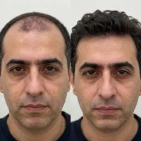 مدل اقا برای تولید محتوای کاشت مو و پروتز مو