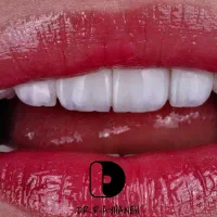 کامپوزیت دندان/لمینت