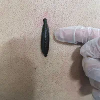 زالو بهداشتی