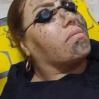 لیزر مو زائد ۴۰۰ کربن تراپی صورت ۶۰۰ حذف تتو ۴۰۰