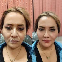 جشنواره خدمات زیبایی ژل، بوتاکس،جوانساز