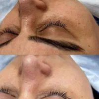 پاکسازی و فیشال تخصصی صورت