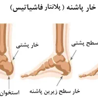 درمان خارپاشنه و تنگی کانال کارپال