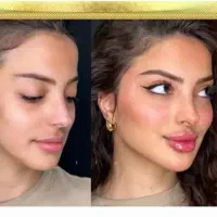فیلر ژل لب بوتاکس تخصصی پزشک کلینیک تهرانسر|خدمات آرایشگری و زیبایی|اسلام‌شهر, باغ فیض|دیوار