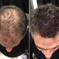 پول کاشت نده بیا درمان شو|آرایشی، بهداشتی، درمانی|اصفهان, احمدآباد|دیوار