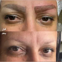 ریموو تخصصی در یک و یا دو جلسه