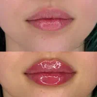 مطب پوست مو تزریق بوتاکس فیلر مزوتراپی هایفو