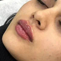 بوتاکس ژل پی ارپی پوست و مو انزیم