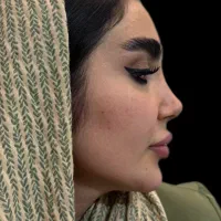 10 میلیون تخفیف عمل جراحی بینی بدون تامپون،لیفت|خدمات آرایشگری و زیبایی|فردیس, طالقانی|دیوار