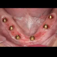 دندان پزشکی و ایمپلنت با اقساط ۶۰ ماهه