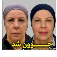 جشنواره لیفت/جوانسازی/انواع هایفو/در1جلسه فقط ۸۹۰ت