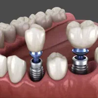 ایمپلنت فوری دیجیتال