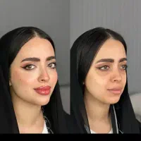 زیبایی و لیفت لب و صورت