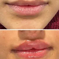 خدمات ژل .فیلر .فول بادی