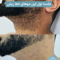 قویترین دسگاه لیزرمو زائد۲۰۲۶+بوتاکس رایگان/خط ریش