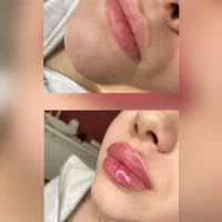 ژل هر سی سی ۵۵۰/بوتاکس ۵۵۰/و مزوتراپی ۶۰۰