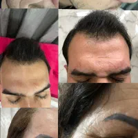 مزوتراپی ژل بوتاکس فصد خون حجامت سرم امپول