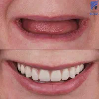 خدمات دندان باوام۲۰۰میلیونی ، قراردادباهمه بیمه ها