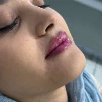 آموزش فیلر و بوتاکس